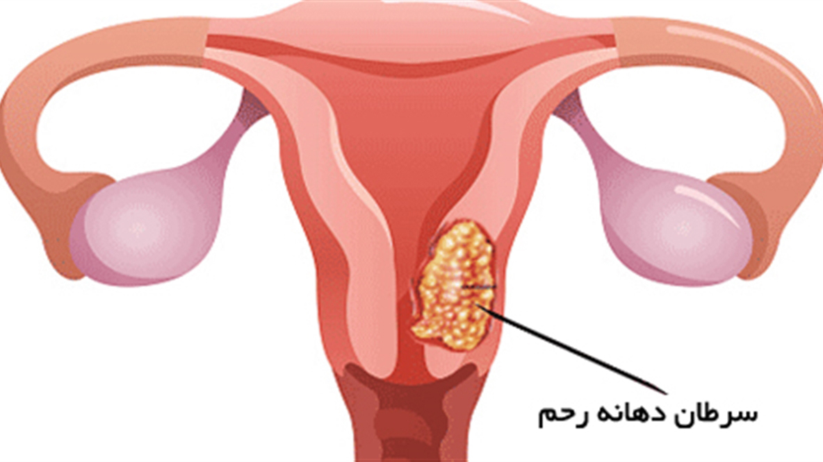 راه های تشخیص سرطان رحم در خانم ها توسط پزشکان به چه صورت است؟